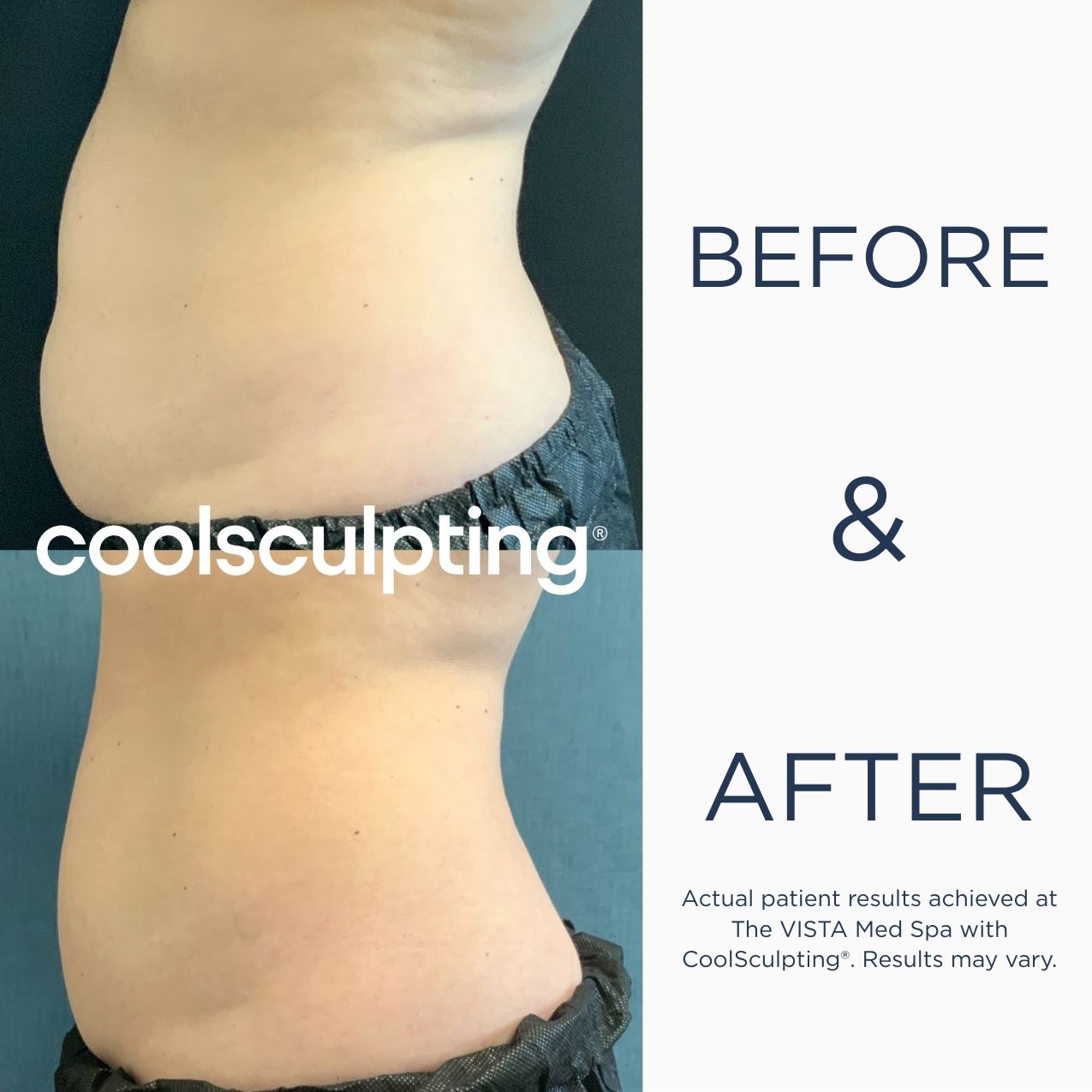 Before and after CoolSculpting results at The VISTA Med Spa. The top image shows the abdomen before treatment, and the bottom image shows a visibly slimmer, smoother contour after treatment. Actual patient results, results may vary.